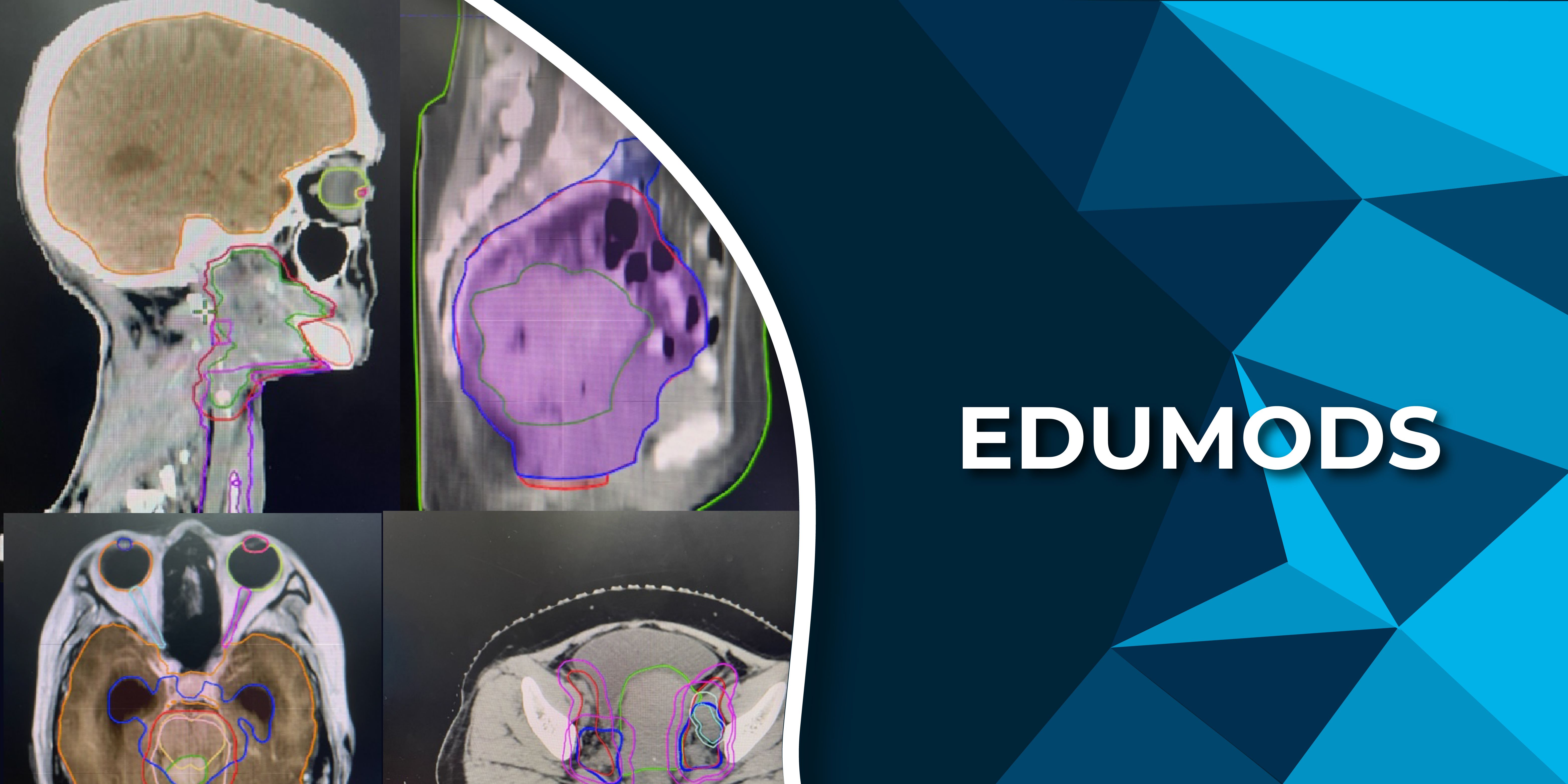 Head and Neck Malignancies